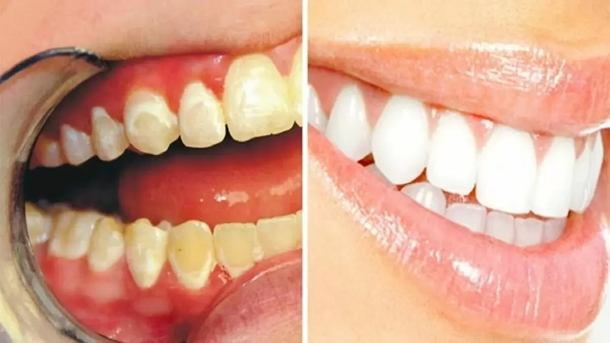 Забота о здоровье зубов: ключевые меры против налета